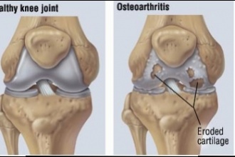 Comparison of aceclofenac with diclofenac in the treatment of osteoarthritis.